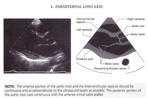 Echo 1 Echocardiogram Overview Handout Flashcards Quizlet