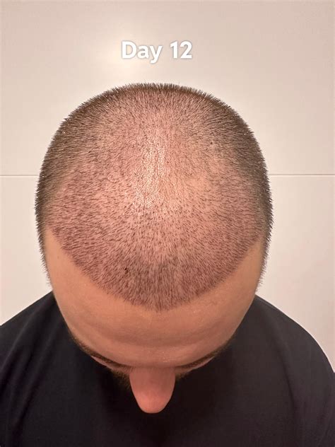 3 Months After My Hair Transplant R Hairtransplants