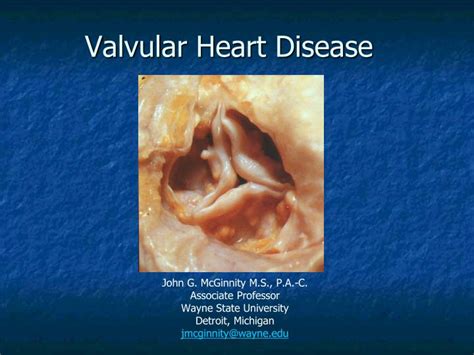 Ppt Valvular Heart Disease Powerpoint Presentation Free Download