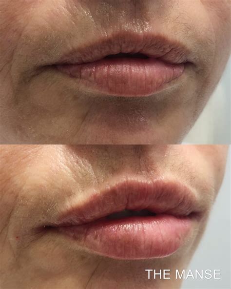 Antiwrinkle Injections For Smokers Lines Lip Lines Best Cosmetic