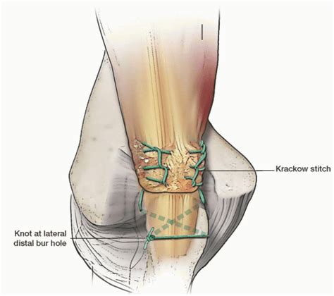 Triceps Tendon Repair | Musculoskeletal Key