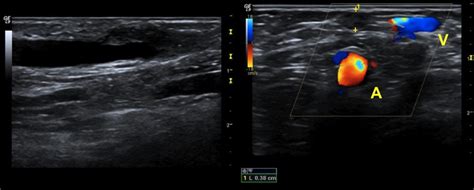 Radio Cephalic Fistula Oclusion Of The Cephalic Vein Just Distal To