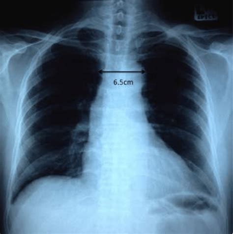 Chest Radiograph Pa Erect Is Normal With No Widened Mediastinum Normal Download Scientific