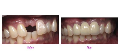 Porcelain Fused to Metal Bridge | Enhance Dental