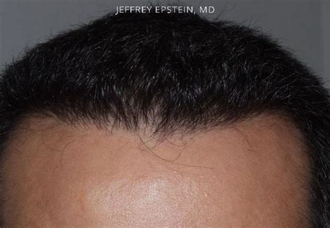 Close Up Hair Transplant Photos Hair Restoration Miami