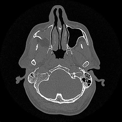 Silent Sinus Syndrome Radiology Captions Pages