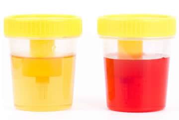 Sangue Nelle Urine Ematuria