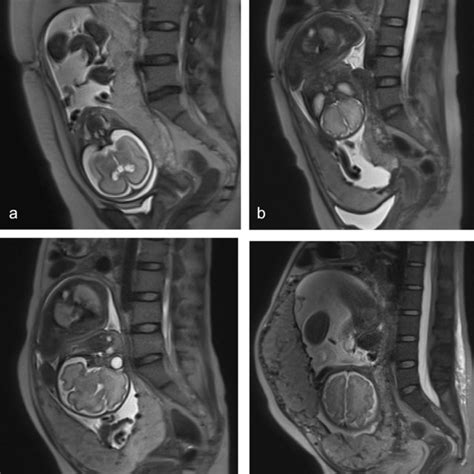 Roc Of Prior Cs Placental Thickness And The Combination Of The Two