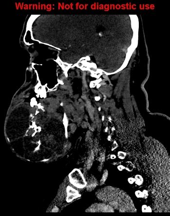 Ameloblastoma Image Radiopaedia Org