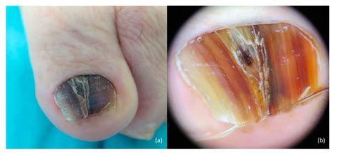 Jcm Free Full Text Cutaneous And Mucosal Melanomas Of Uncommon