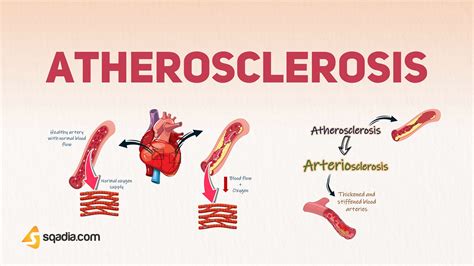 Atherosclerosis Introduction