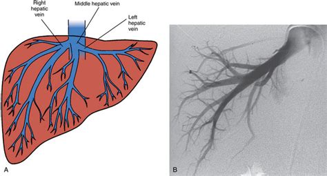 Hepatic Splenic And Portal Vascular Systems Radiology Key