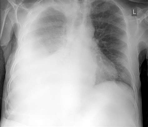 Pleural Effusion Chest X Ray Medschool Lights Crystal