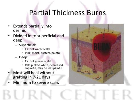 Ppt Burns In The Emergency Department Powerpoint Presentation Free Download Id3314883