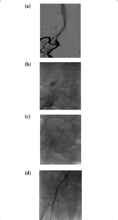 Pt With Phlebography Images With Right Iliac Vein Obstruction And