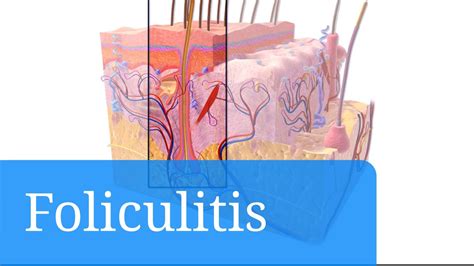 Foliculitis Causas Tratamiento Y Consejos Para Prevenirla Youtube