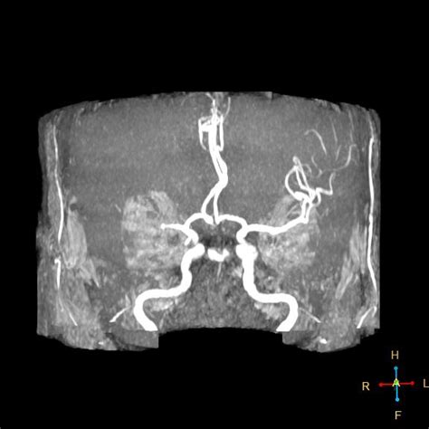 Mca Territory Infarction Image