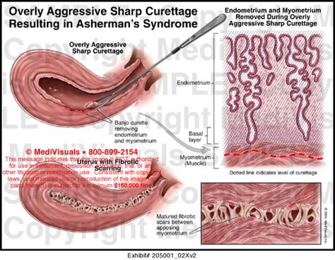 Medivisuals Overly Aggressive Sharp Curettage Resulting In Ashermans