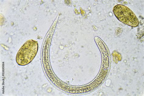 Strongyloides Stercoralis And Eggs Of Helminth In Stool Analyze By