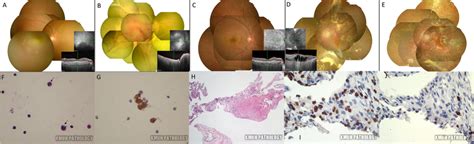 A 62 Year Old Female With Bilateral Intraocular Lymphoma Montage Download Scientific Diagram