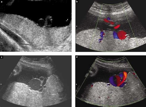 Umbilical Artery Ultrasound