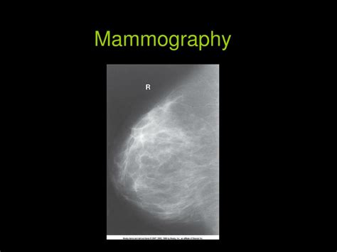 Ppt Mammography Powerpoint Presentation Free Download Id 4362688