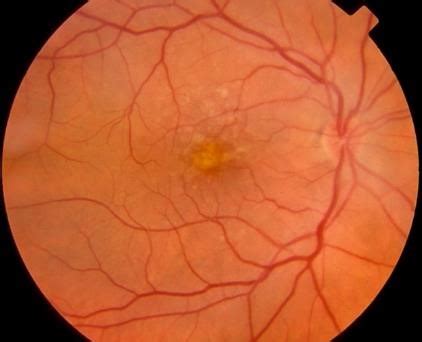 Moran Core Retina Rpe Histopathology