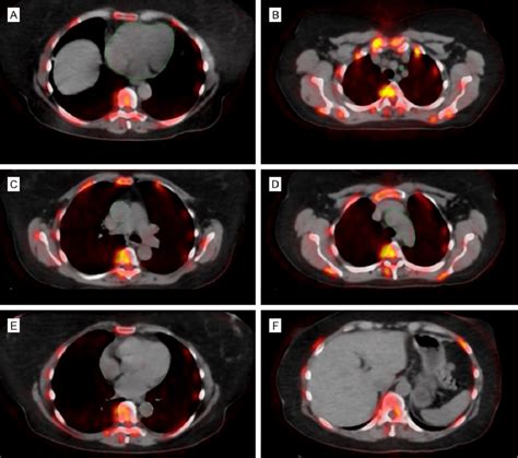 Axial Fused Naf Pet Ct With Regions Of Interest Depicting Non Lower