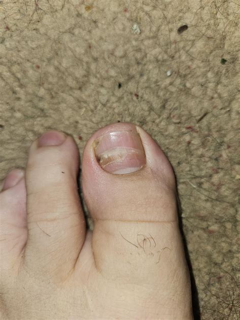 Weird toe nail : r/medical