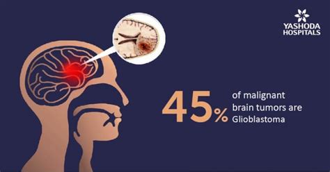 Glioma Causes Symptoms Diagnosis And Treatment