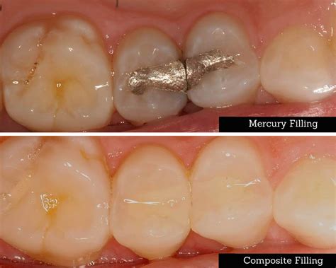 How Do Composite Fillings Work Ilana Ponce