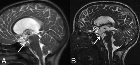 Hydrocephalus Mri