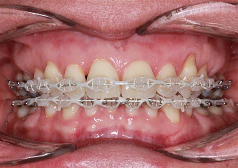 A Full Guide Of Orthodontic Braces Types Duration And Costs