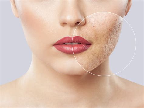 5 Different Types of Skin Blemishes on The Face And Its Treatments ...