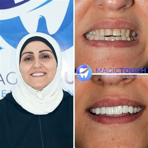 Before/After - MagicTouch Dental Clinic Turkey