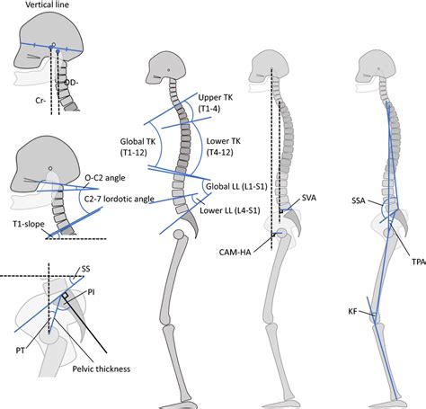 Spinopelvic Parameters And Whole Body Sagittal Alignment Parameters