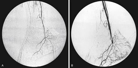 Graft Thrombosis Clinical Tree