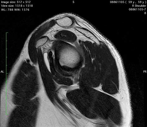 Right Shoulder Mri