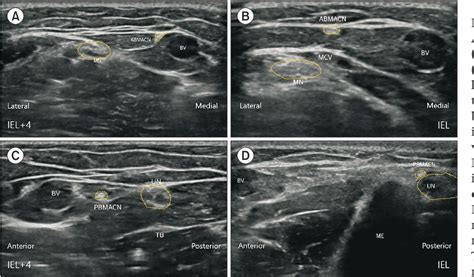 Figure 1 From Ultrasonographic Identification Of The High Risk Zone For Medial Antebrachial