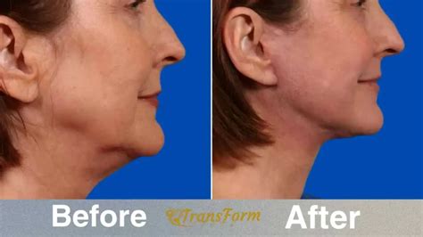 Neck Lift Before and After: My Jaw-Dropping Transformation