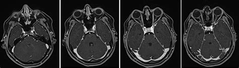 Cavernous Sinus MRI | MRI Cavernous Sinus Protocol and Planning