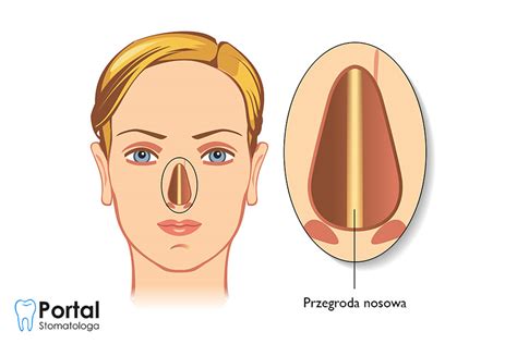 Przegroda Nosowa Portal Stomatologa