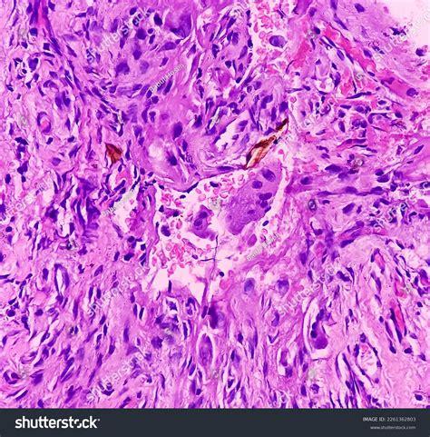 Oral Submucous Fibrosis Poster