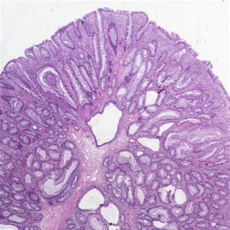 (PDF) A juvenile polyp on colonoscopy, is it premalignant?