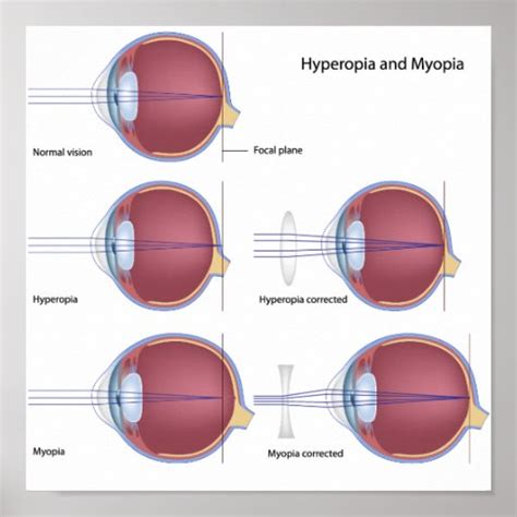 Common Eye defects Poster | Zazzle