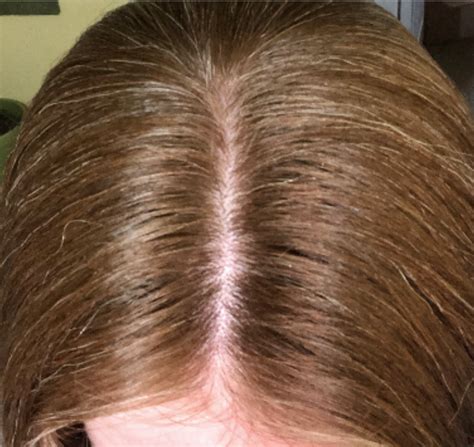 Do I Just Need Patience Or Is My Hair Density Not Going To Fully Return — Donovan Hair Clinic