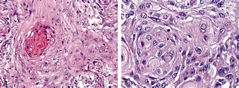 CÁncer Epidermoide De EsÓfago Binipatia E Higienismo