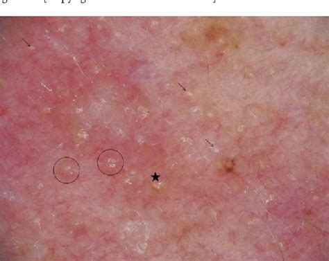 Figure 4 From Usefulness Of Dermoscopy In The Diagnosis And Monitoring