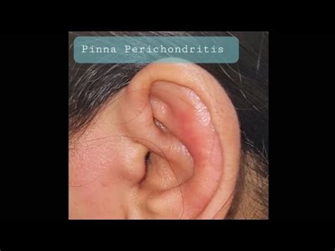 Earache Pinna Perichondritis Drbaisalisarkar Entsurgeon Facial