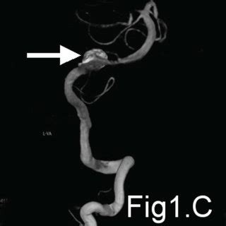 Ac Show The Mra Cta And D Dsa Respectively Of Basilar Artery